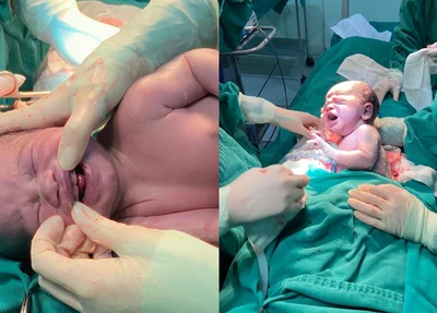 Bebê nasce com seis dentes e surpreende equipe médica