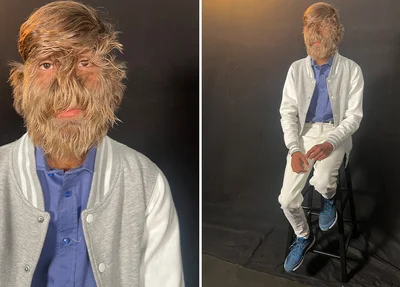Homem mais peludo do mundo é indiano