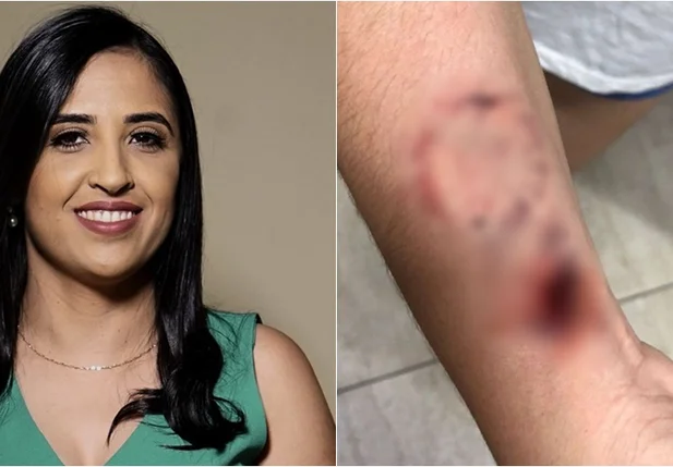 Prefeita Dra. Kaylanne foi acusada de ferir enfermeira com mordidas