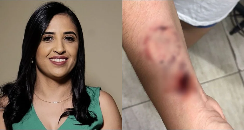 Prefeita Dra. Kaylanne foi acusada de ferir enfermeira com mordidas