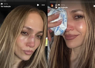 Jennifer Lopes publicou ferimentos no rosto