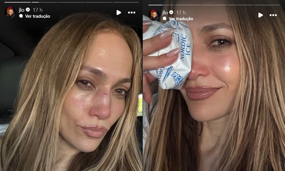 Jennifer Lopes publicou ferimentos no rosto