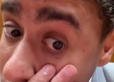 Nikolas Ferreira ficou com o rosto ferido