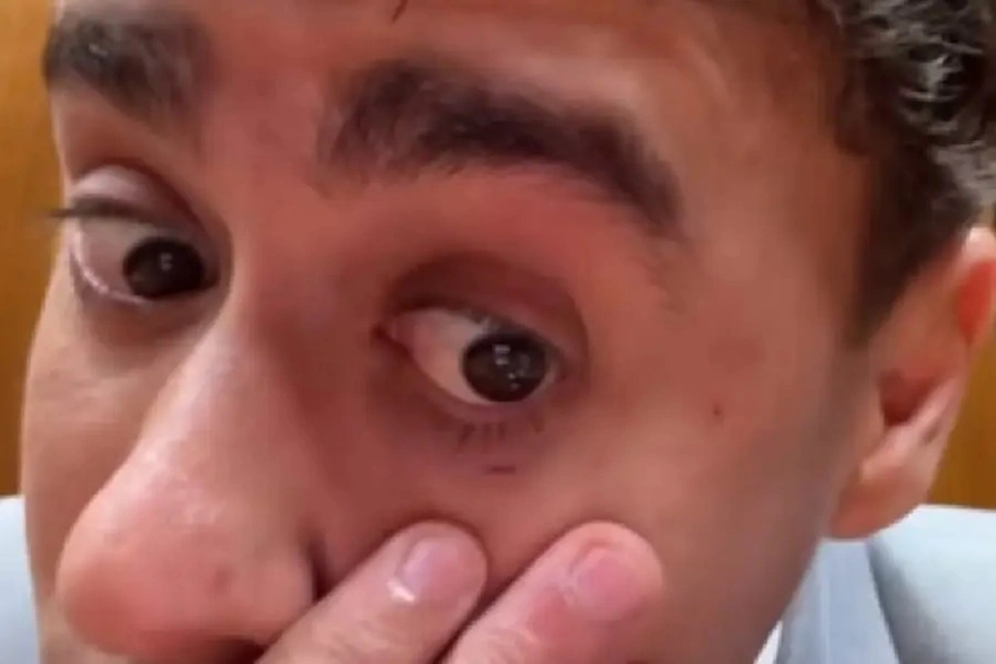 Nikolas Ferreira ficou com o rosto ferido