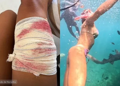 Turista Tayane Dalazen, de 36 anos, foi mordida por um tubarão