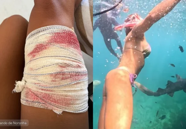 Turista Tayane Dalazen, de 36 anos, foi mordida por um tubarão