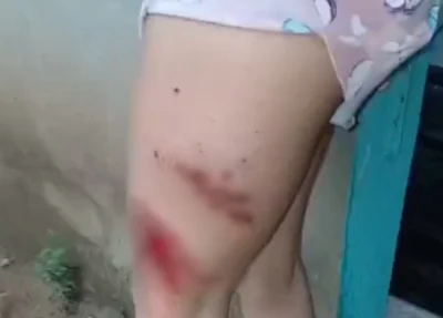 Mulher fica ferida após ser atingida por raio