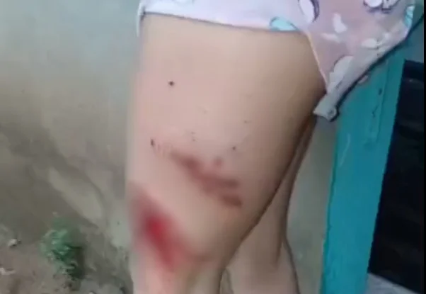 Mulher fica ferida após ser atingida por raio