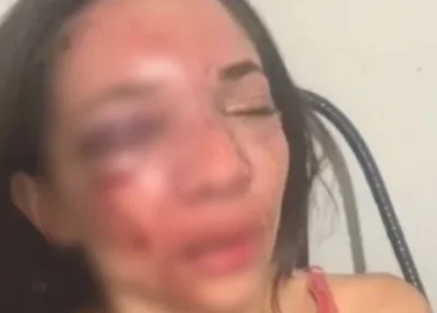Mulher tem rosto desfigurado após ser agredida pelo namorado em Picos