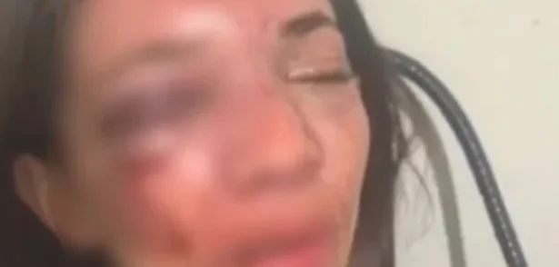 Mulher tem rosto desfigurado após ser agredida pelo namorado em Picos