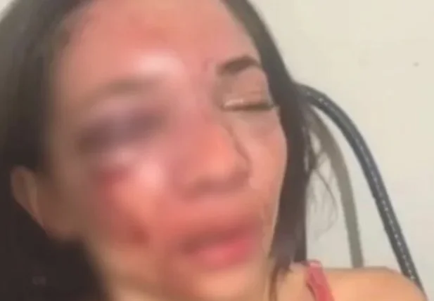 Mulher tem rosto desfigurado após ser agredida pelo namorado em Picos