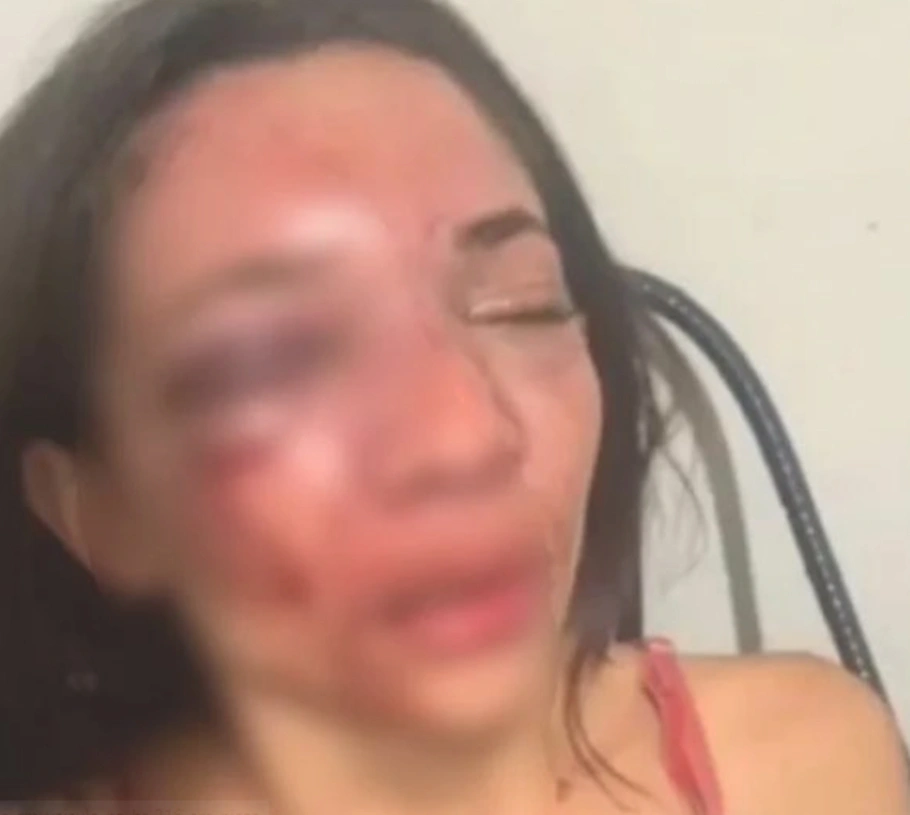 Mulher tem rosto desfigurado após ser agredida pelo namorado em Picos