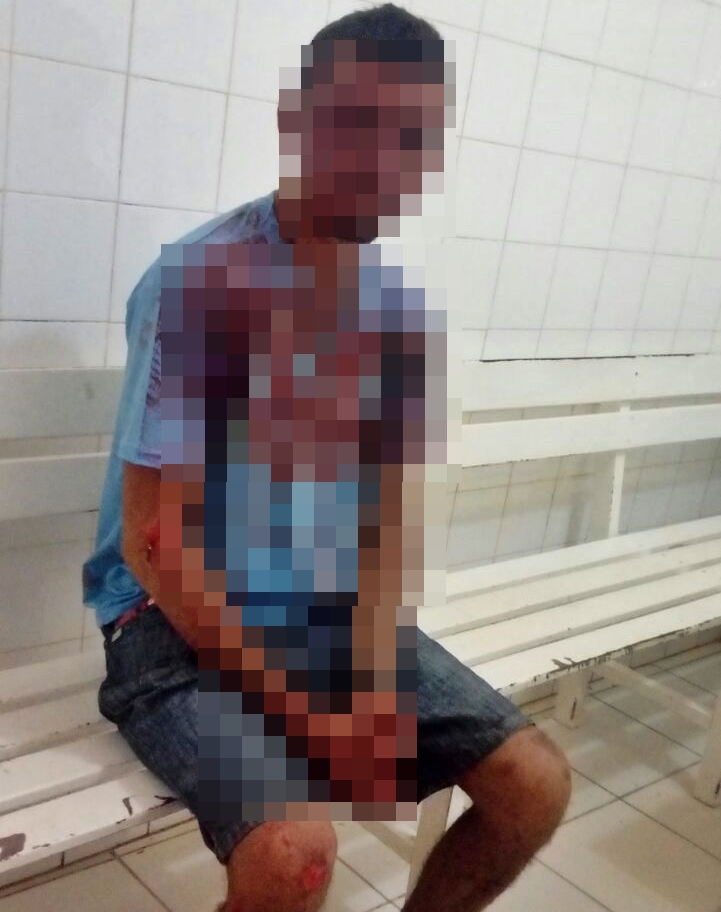 Motoqueiro fica ferido enquanto tentava capturar pokemóns no Piauí