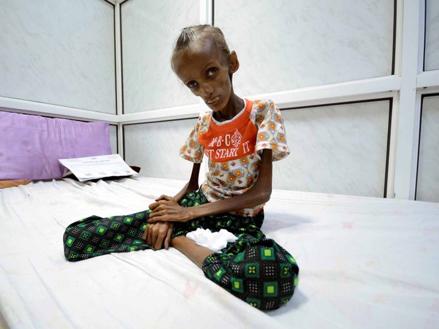 Criança desnutrida no Iêmen