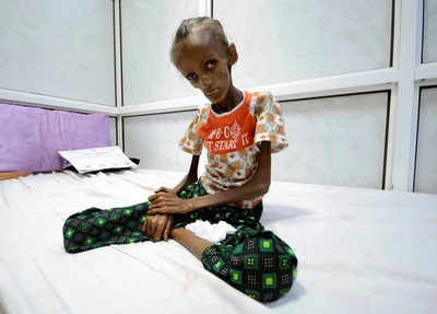Criança desnutrida no Iêmen