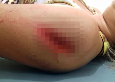 Mulher teve ferimento no braço e na mão