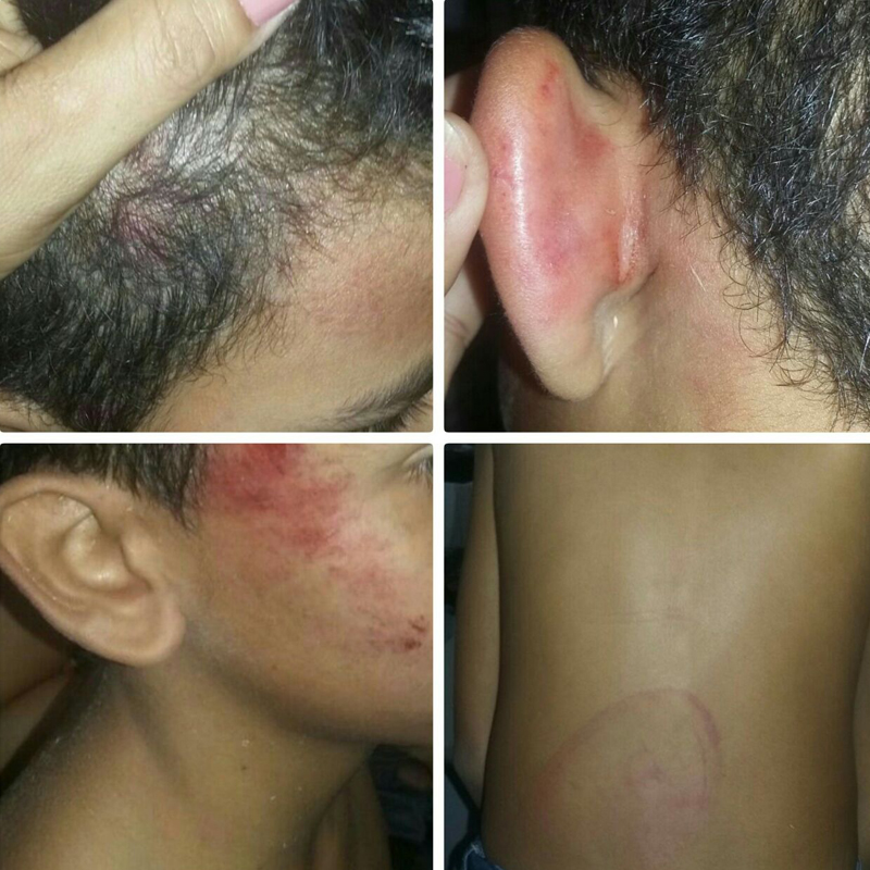 Marcas mostram agressão contra uma das crianças