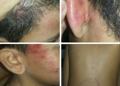 Marcas mostram agressão contra uma das crianças