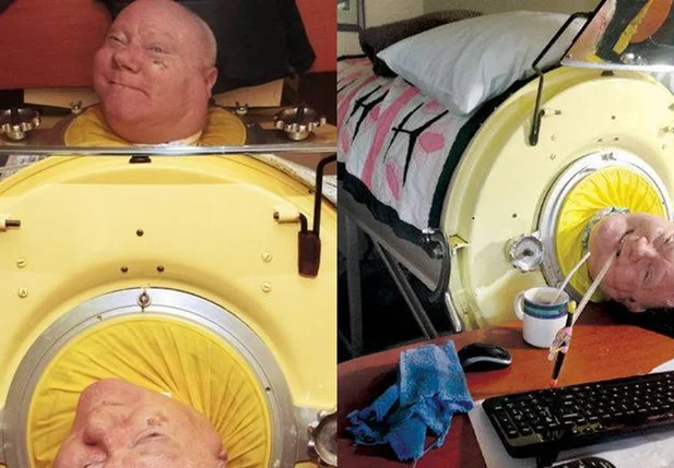 Advogado Paul Alexander viva há 64 anos preso em máquina nos EUA