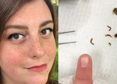 Kate Holley passou nove dias com o inseto dentro do ouvido