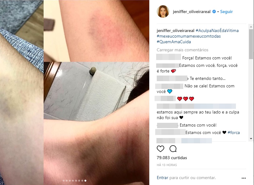 Marcas das agressões em Jeniffer Oliveira