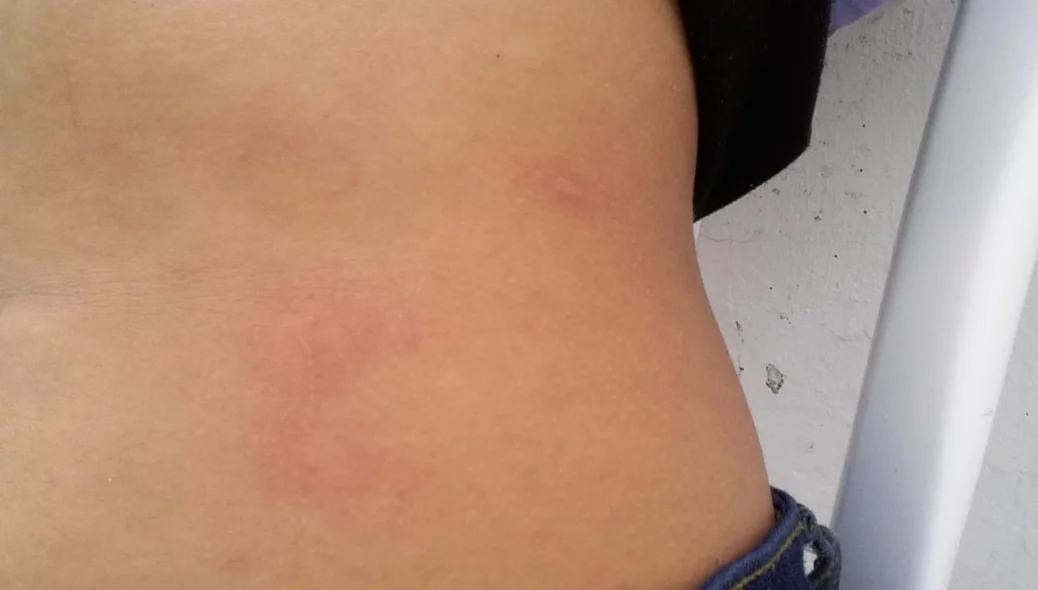 Estudante mostra marcas