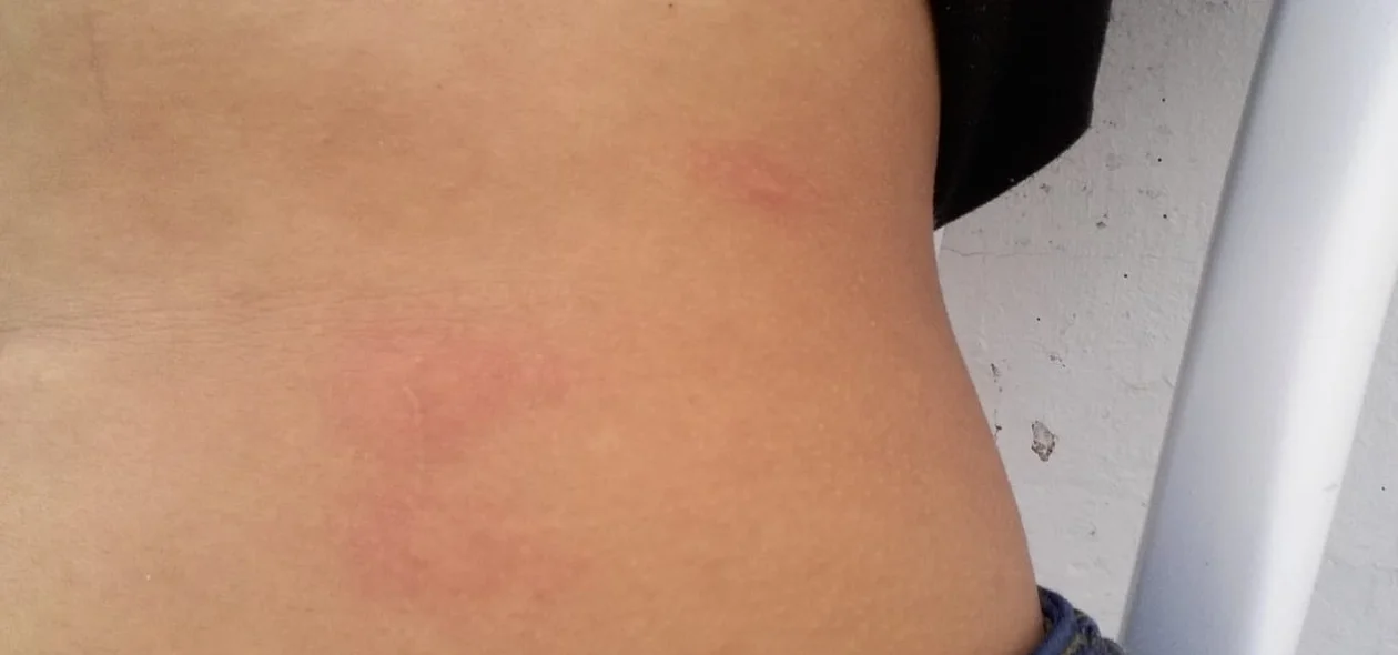 Estudante mostra marcas