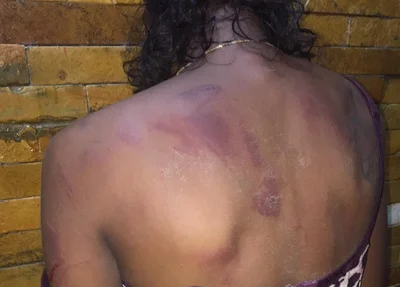 Marcas das agressão estão em várias partes das costas