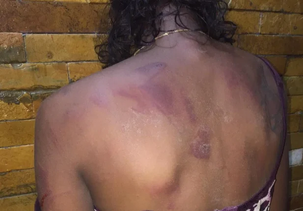Marcas das agressão estão em várias partes das costas