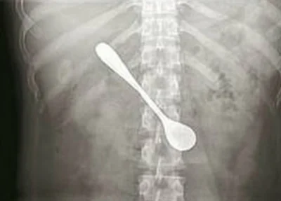 A chinesa engoliu acidentalmente a colher ao tentar retirar uma espinha de peixe da garganta