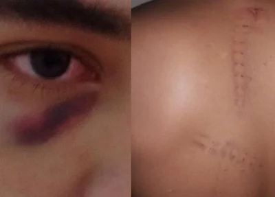 Jovem que sofreu agressão no CEM