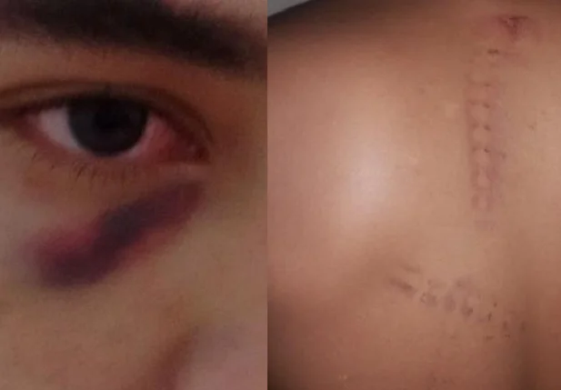 Jovem que sofreu agressão no CEM